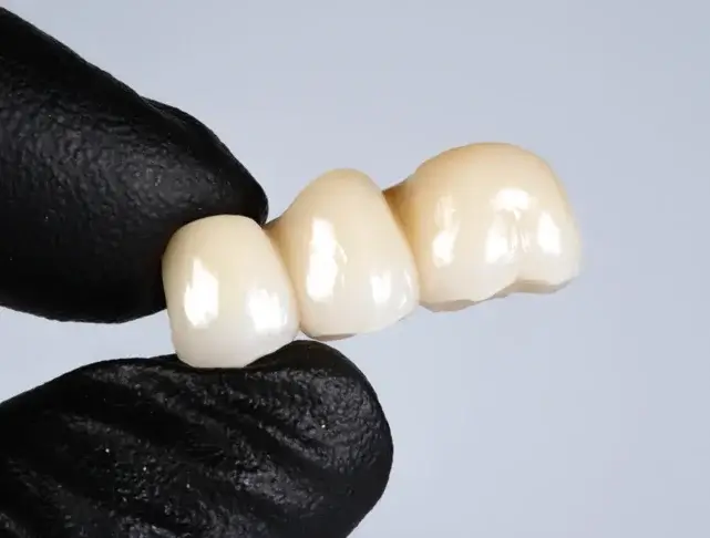 Close-up of a gloved hand holding a three-unit ceramic dental bridge, crafted for tooth replacement at Dentarts Prosthodontics in Sienna, Missouri City, TX